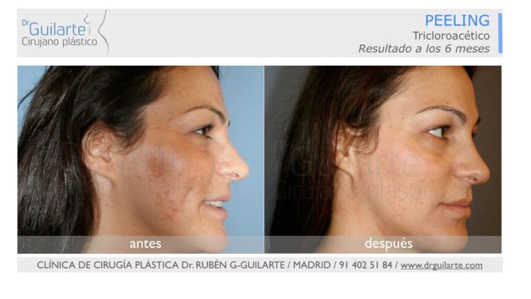 Peeling Químico: Guía Completa de Rejuvenecimiento