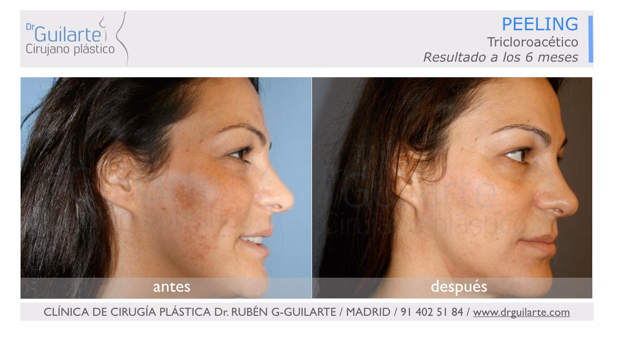¿Qué es un peeling quirúrgico?