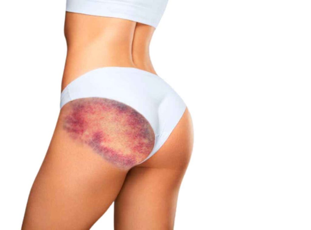 Lifting de Glúteos: Elimina la Piel Sobrante