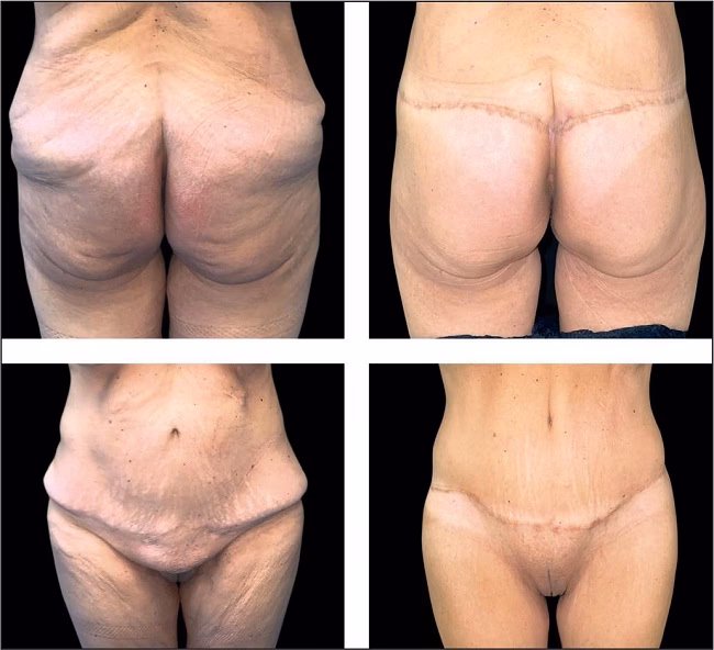 ¿Cómo eliminar el exceso de piel en los glúteos?