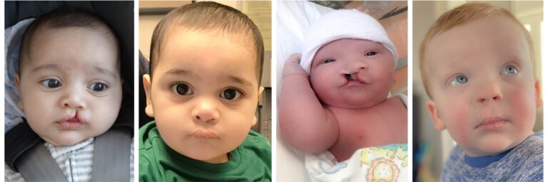 Palatoplastia: Cirugía para el Paladar Hendido