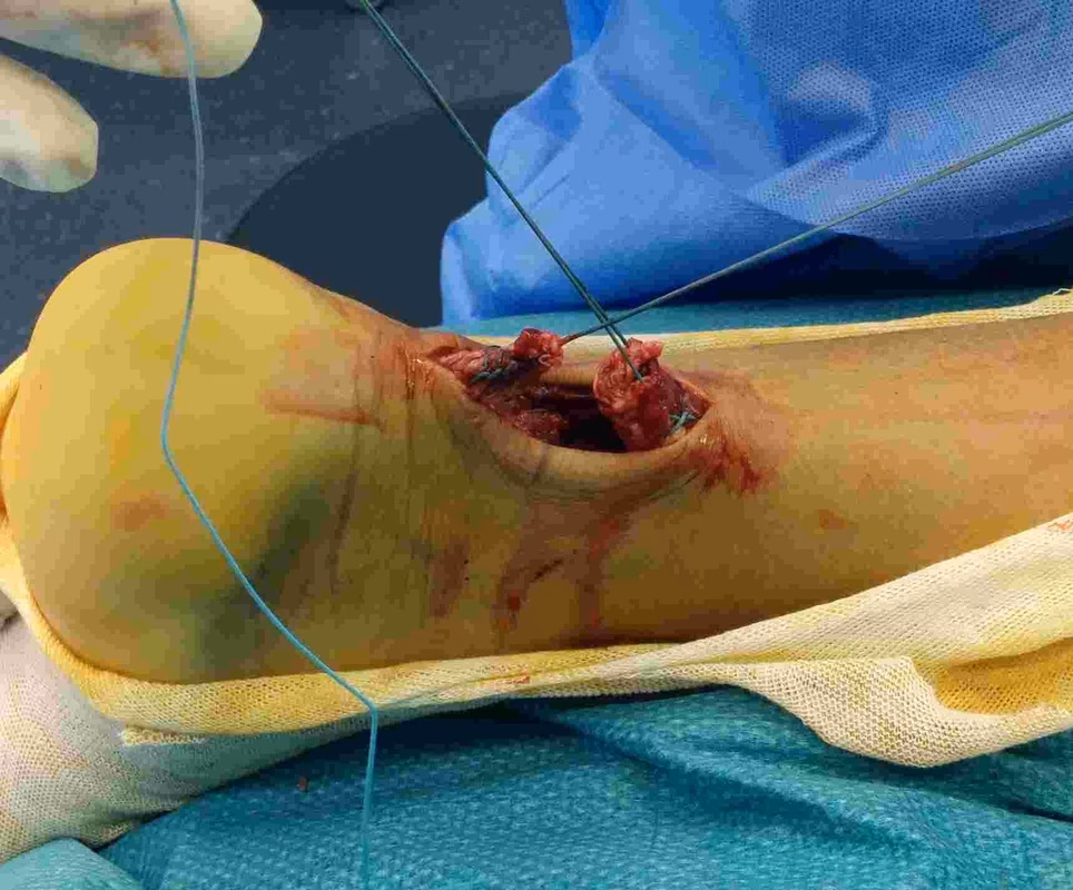 Tendón de Aquiles: Regeneración Sin Cirugía