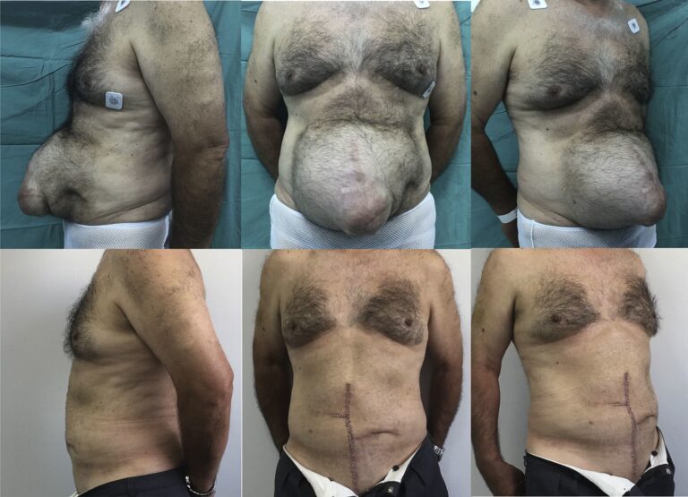 Reparación de la Pared Abdominal: Guía Completa