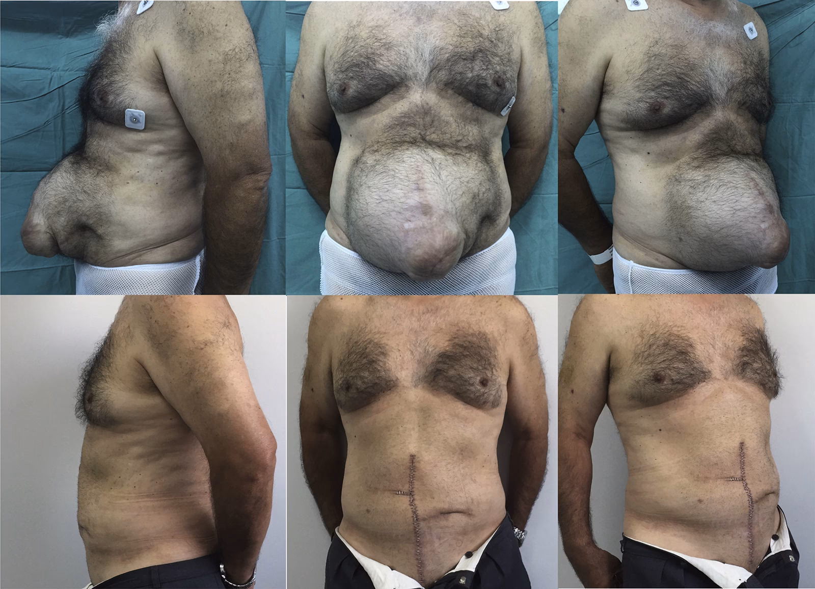 ¿Cómo se puede reparar la pared abdominal?