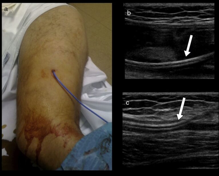Lesión de Morel-Lavallée: ¿Cuándo es necesaria la cirugía?