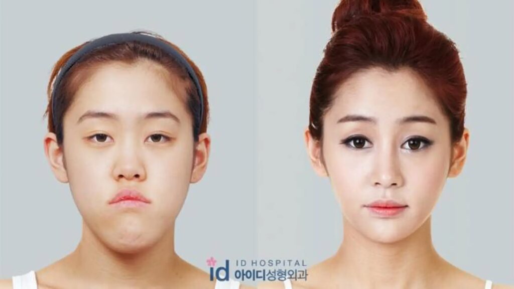 Mejores Hospitales de Cirugía Plástica en Seúl