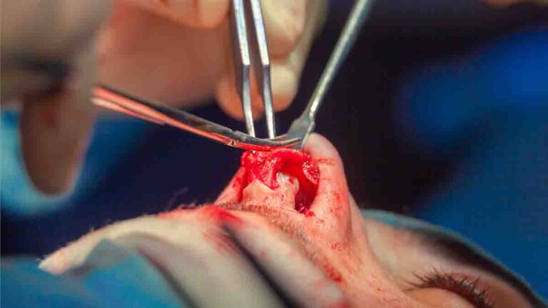 Riesgos de la Rinoplastia: ¿Qué Puede Salir Mal?
