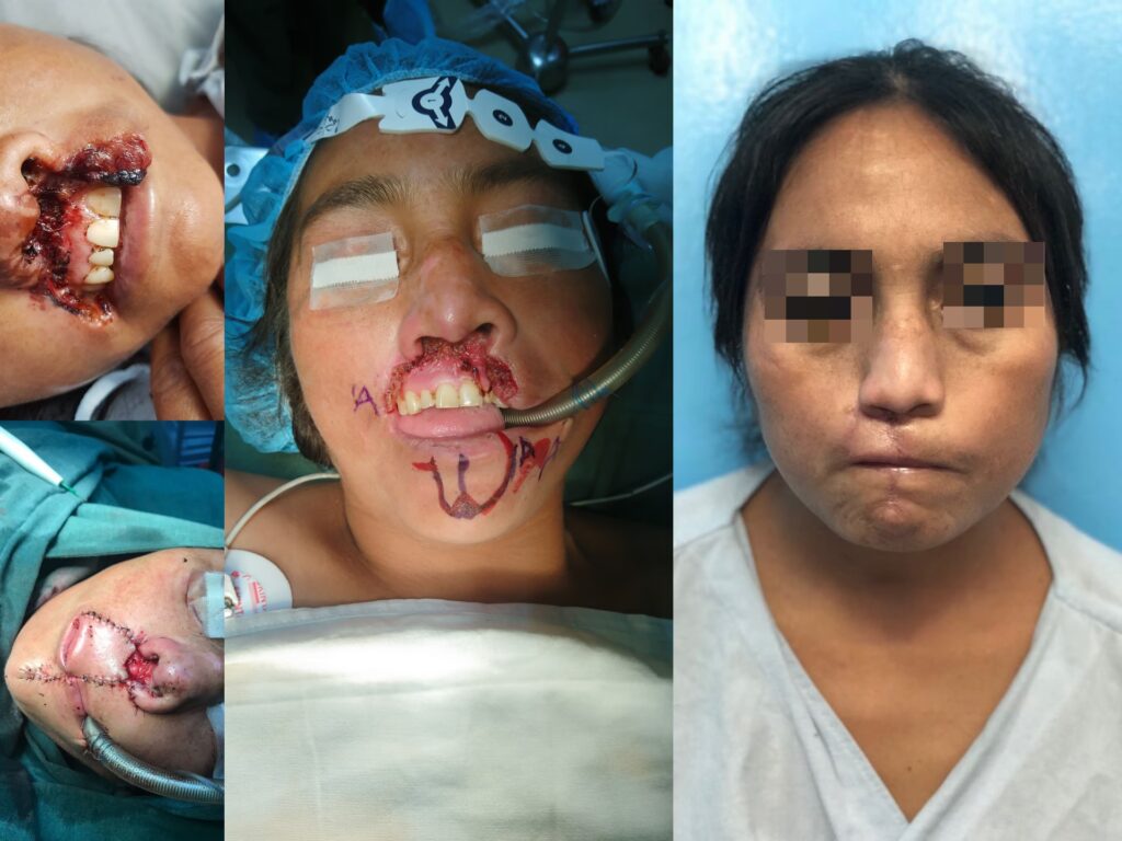 Cirugía Plástica y Trauma: Más Allá de la Estética