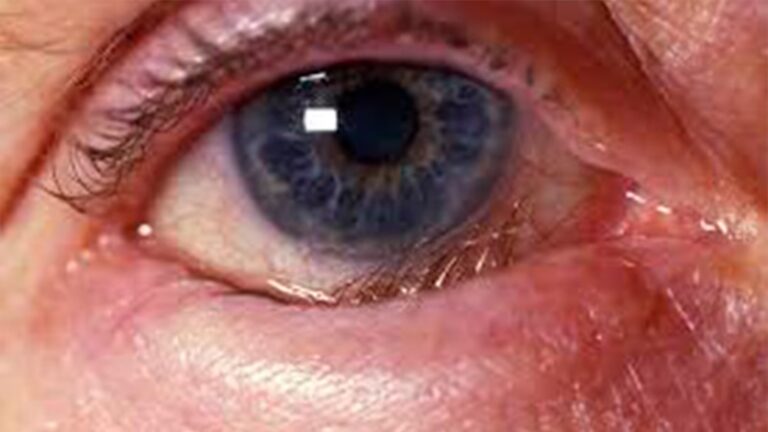 Cirugía de Pterigión y Párpados: Guía Completa