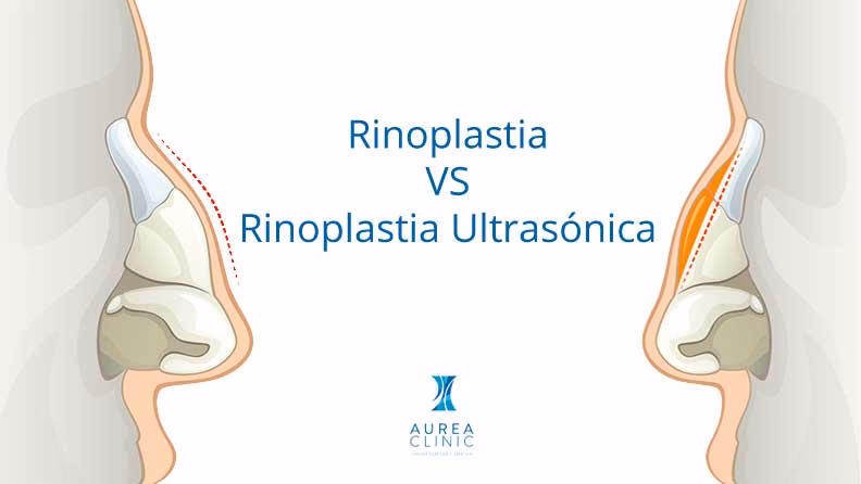 ¿Qué es la liposucción convencional?