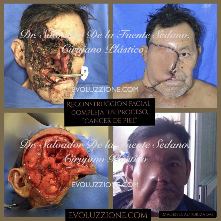 Métodos de Reconstrucción Facial: Arte y Ciencia