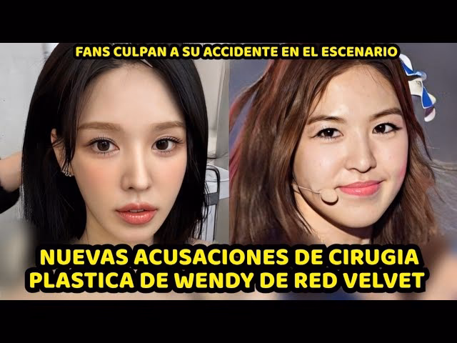 ¿Qué se operó Wendy de Red Velvet?