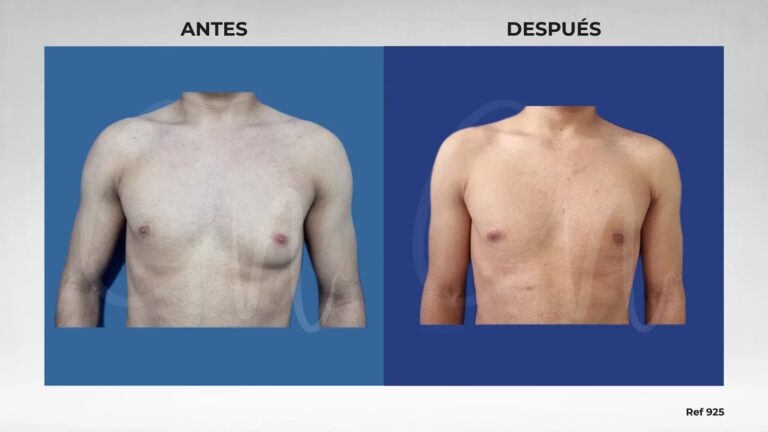 Ginecomastia: La Solución a la Grasa Pectoral