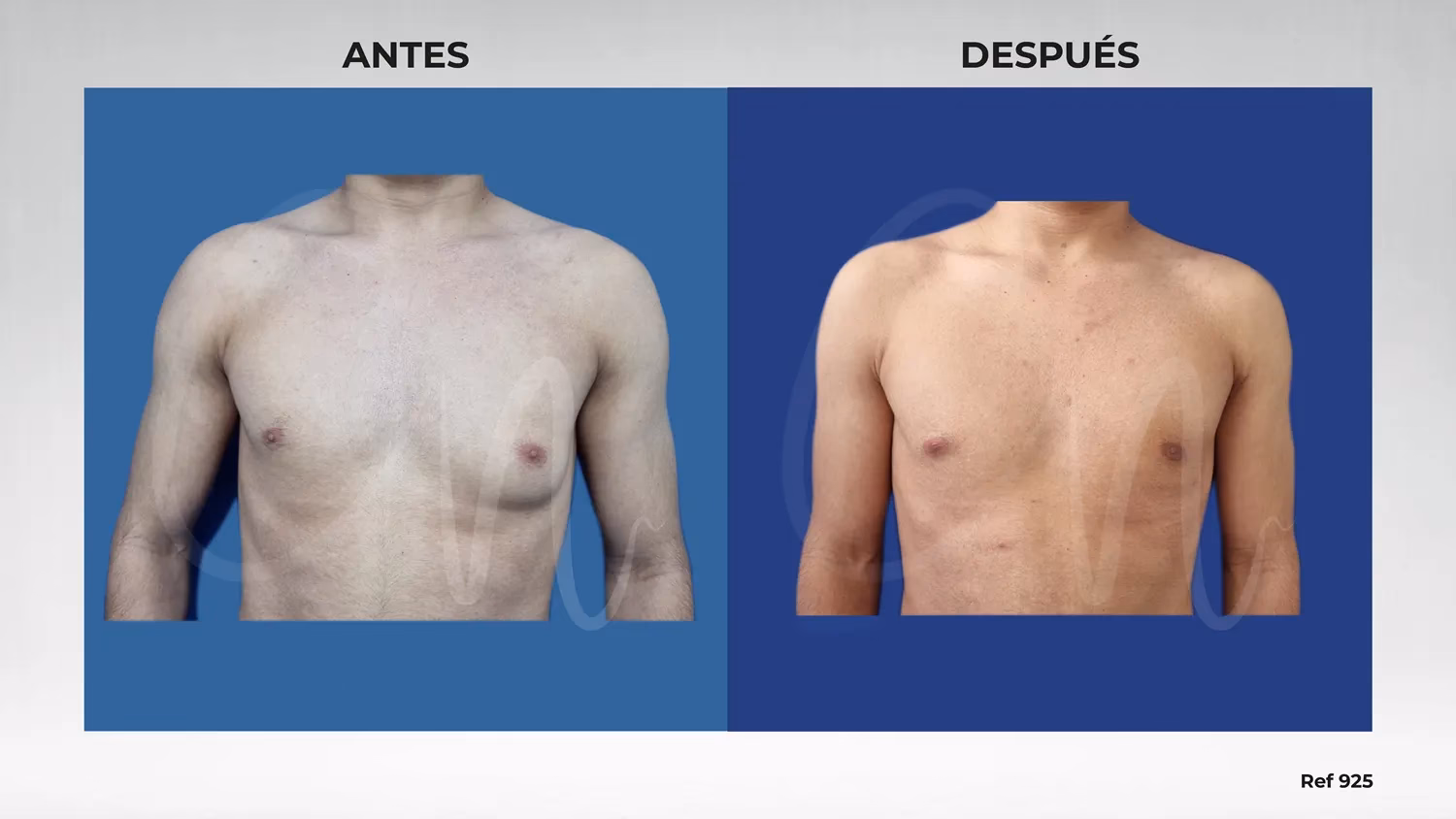 ¿Eliminar grasa pectoral hombre cirugía?