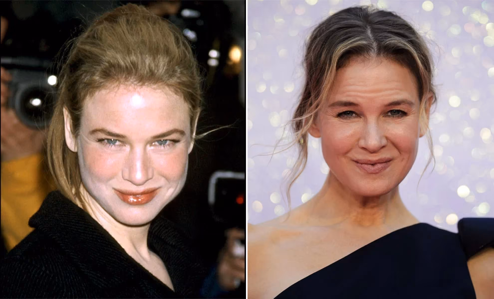 ¿Qué cirugías se hizo Renée Zellweger?