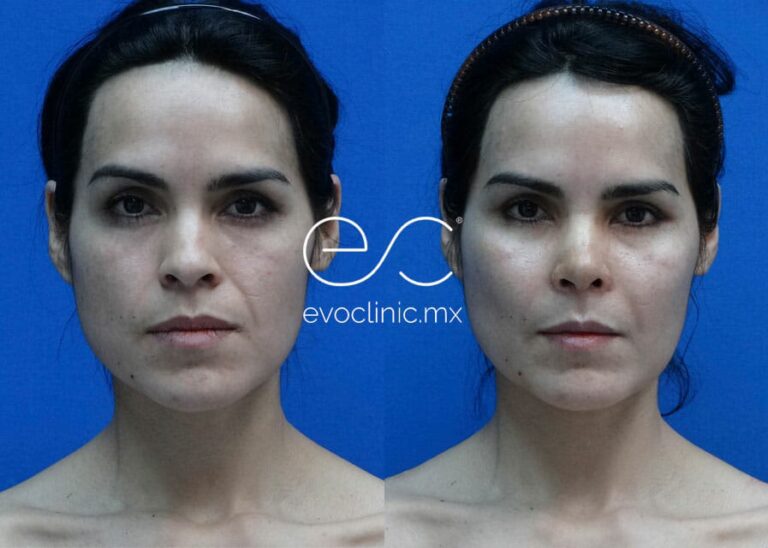 Precio de la Cirugía de Pómulos: Guía Completa