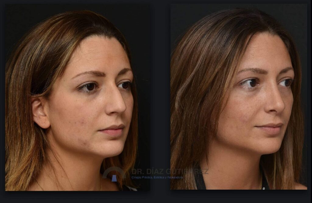 Rinoplastia: ¿Cuándo veré el resultado final?