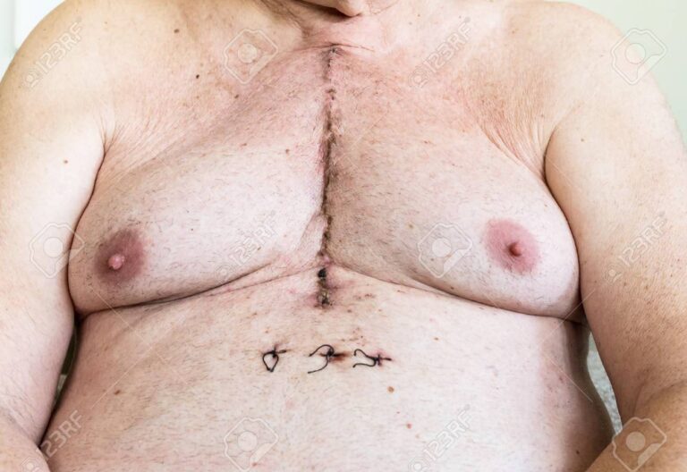 Cirugía sin Cicatriz: ¿Es Posible?