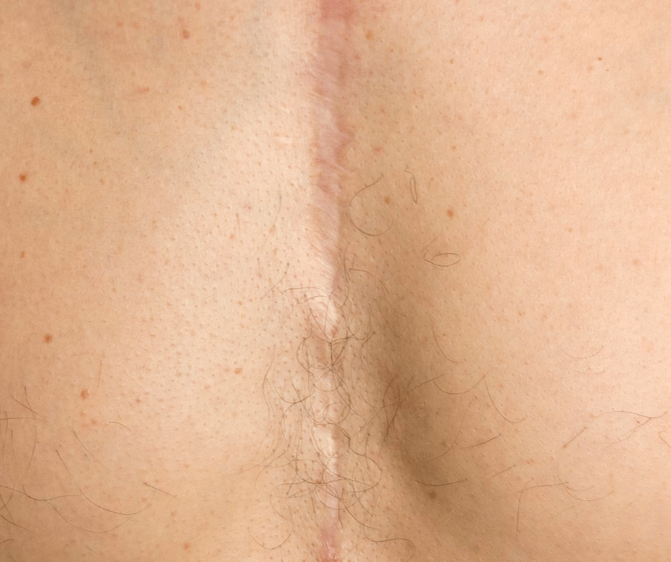 ¿Qué cirugía no deja cicatriz?