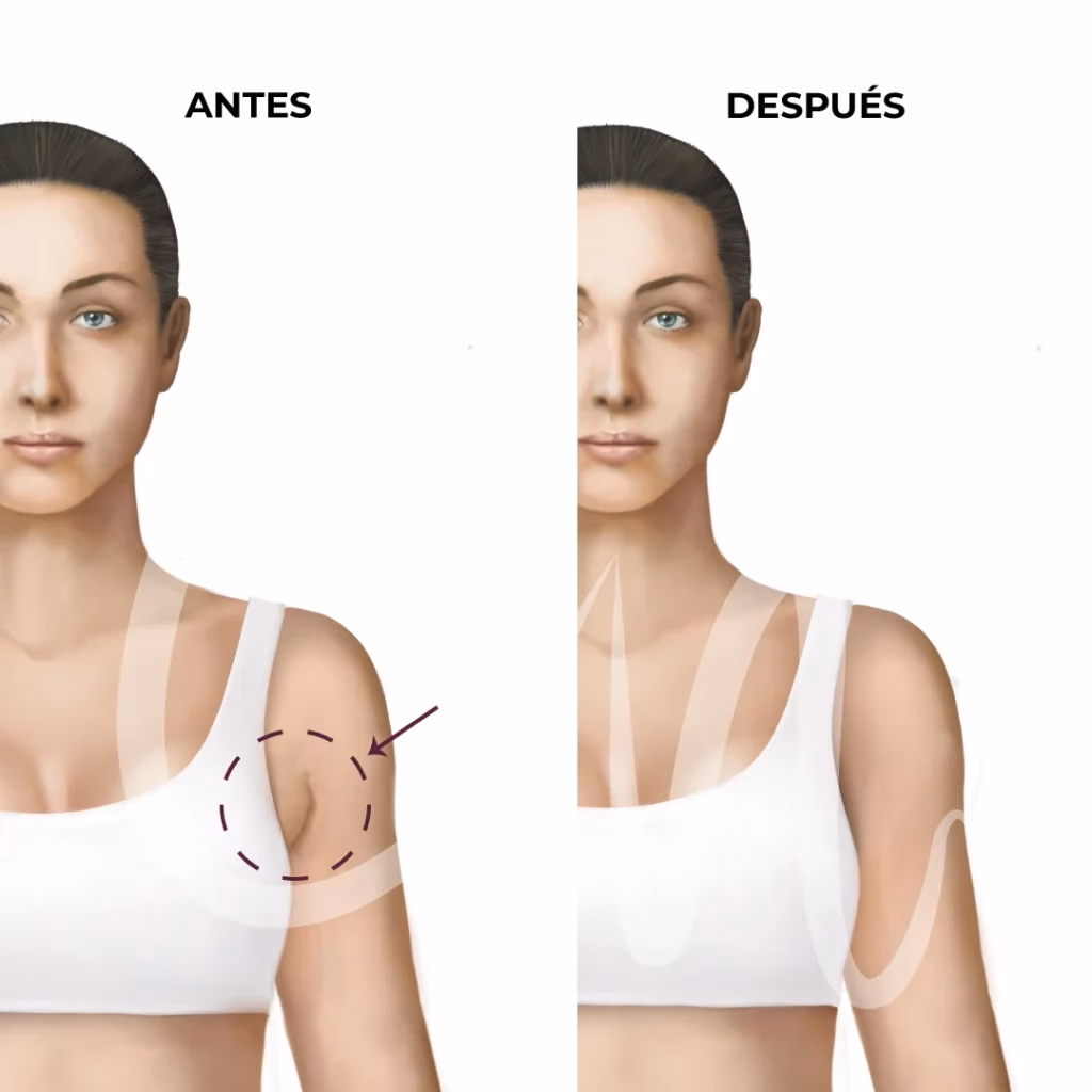 ¿Cuánto cuesta la cirugía de axilas?