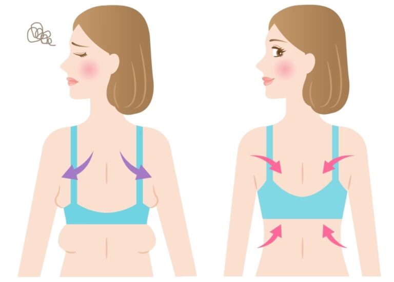 Liposucción de Axilas: Costo, Proceso y Resultados