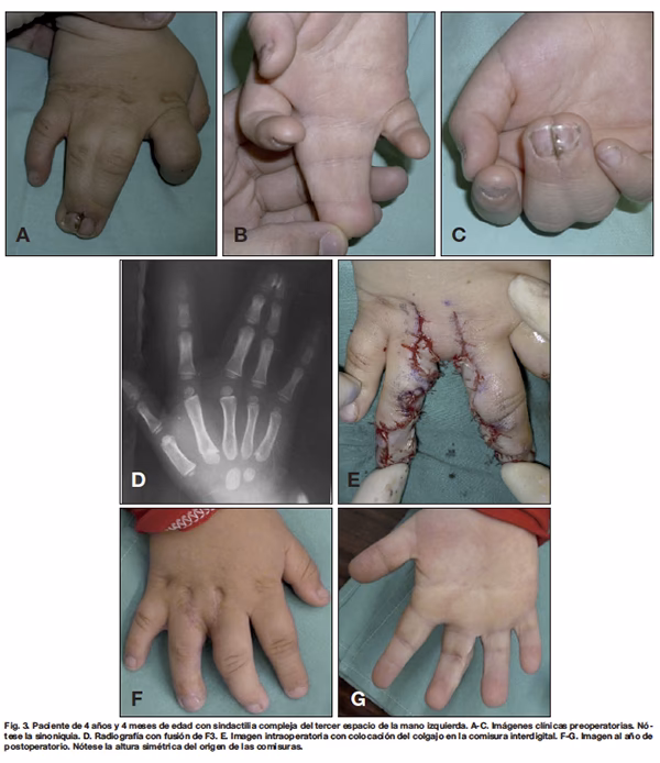 ¿Cuánto cuesta la cirugía de sindactilia?