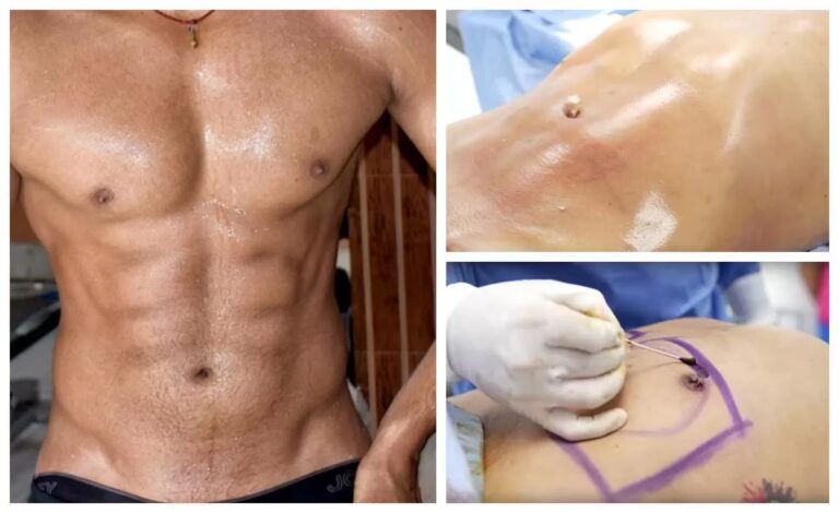 Cirugía Six Pack: Guía para un Abdomen Definido