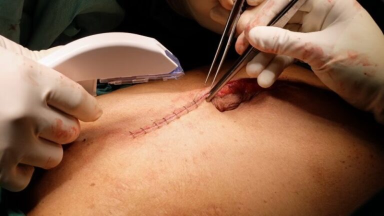El Arte de la Sutura en Cirugía Plástica