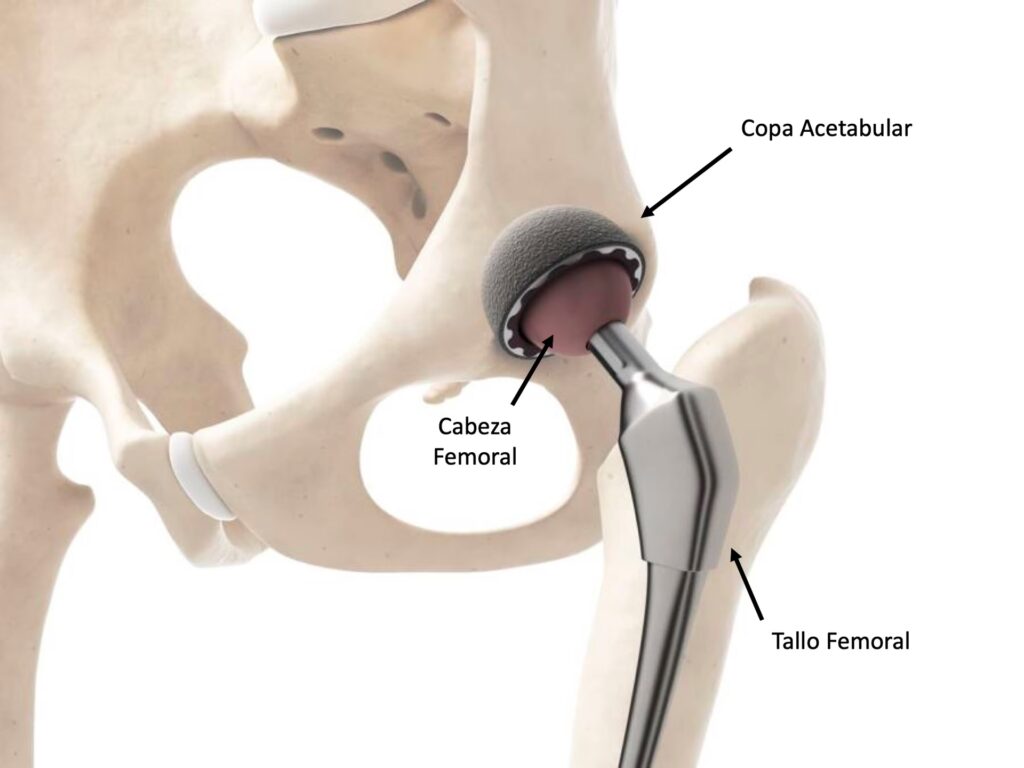 Prótesis de Cadera: Guía Esencial y Tipos
