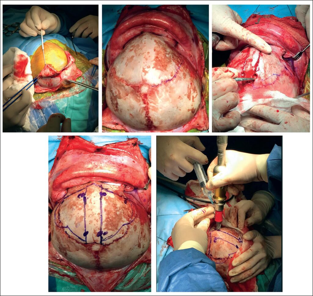 Craneoplastia: Guía Completa de la Cirugía