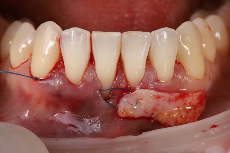 Mentoplastia: La Cirugía para Reducir el Mentón