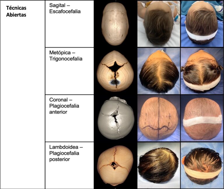 Cirugía Craneal: Una Guía Detallada
