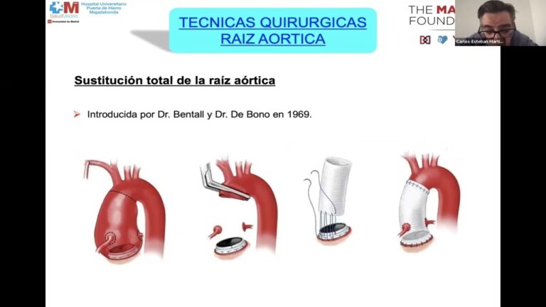 Cirugía de Aneurisma de Aorta: Técnicas y Pronóstico