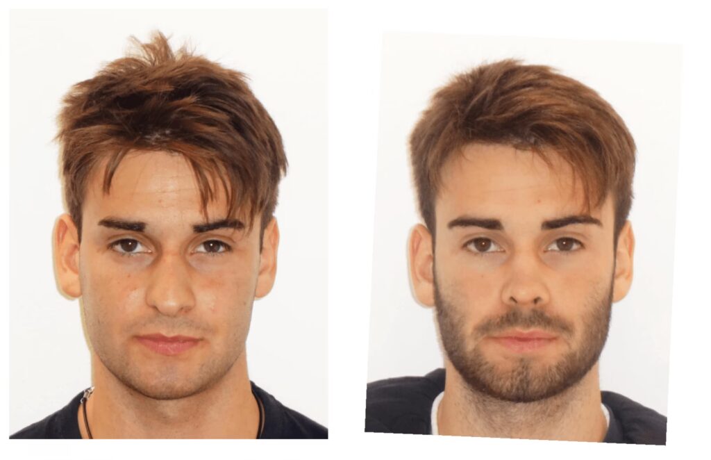 Reposo Post-Rinoplastia: ¿Cuántos días?