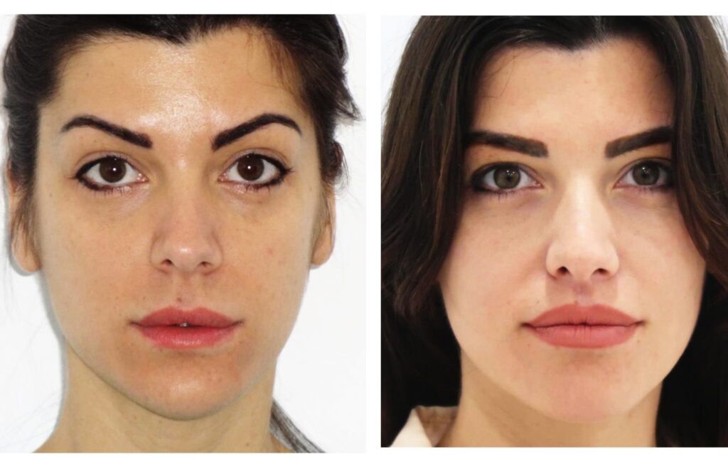 Rinoplastia: Guía de Desinflamación Nasal