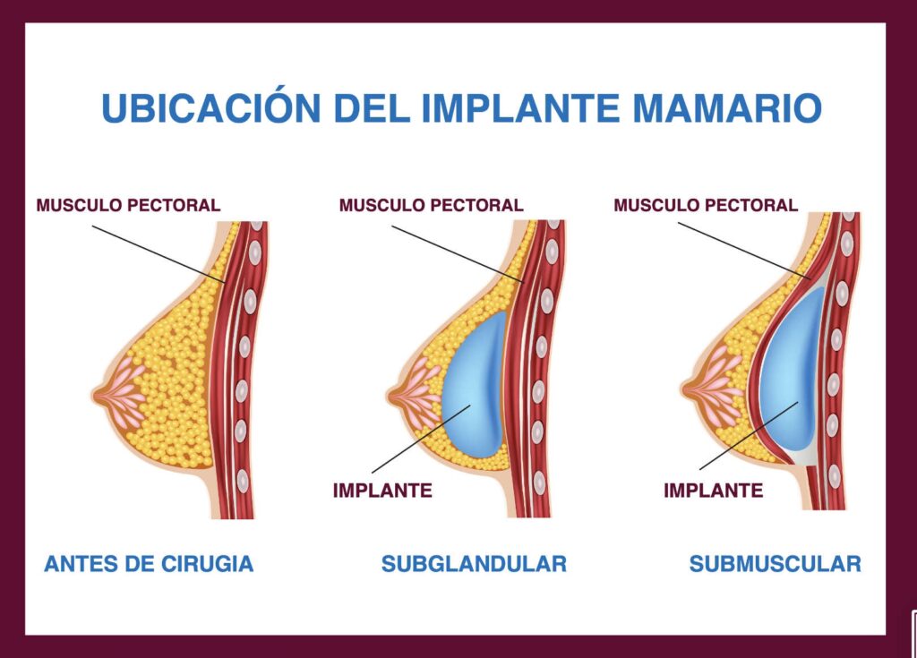 Guía para Elegir el Implante Mamario Perfecto