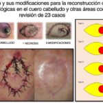 Guía Completa de Colgajos Quirúrgicos