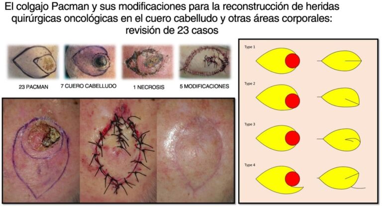 Guía Completa de Colgajos Quirúrgicos
