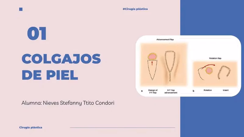 ¿Cuáles son los tipos de colgajos?