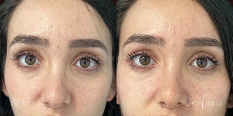 Precio de la Blefaroplastia: Guía Completa