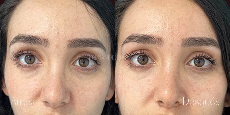Precio de la Blefaroplastia: Guía Completa