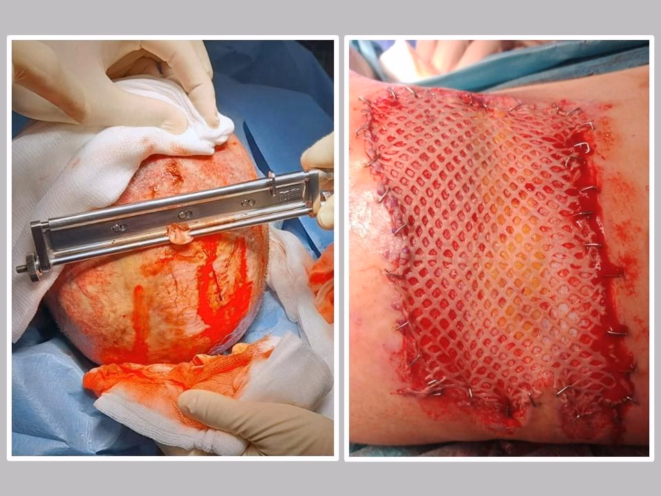 ¿Qué hacen los cirujanos plásticos con las quemaduras?