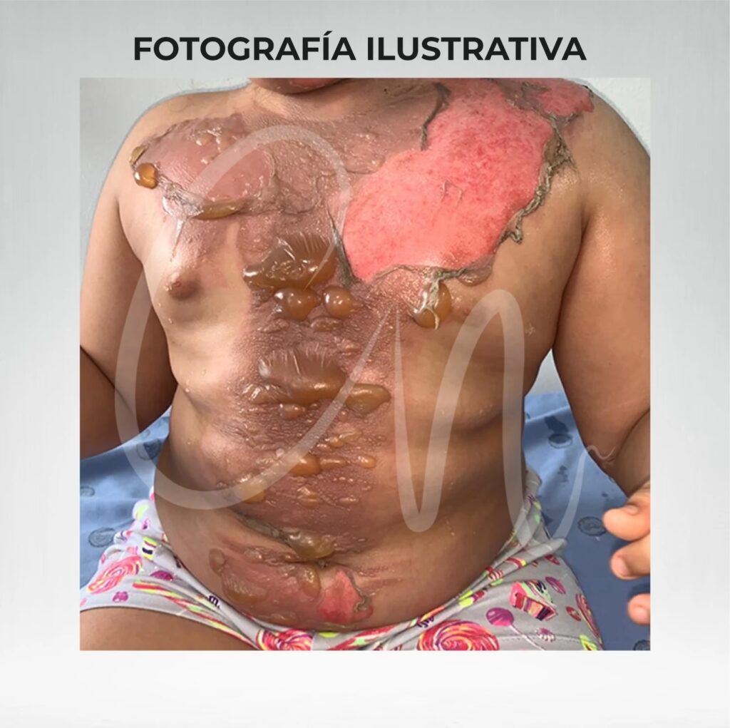 Cirugía Plástica para Quemaduras: Una Nueva Piel