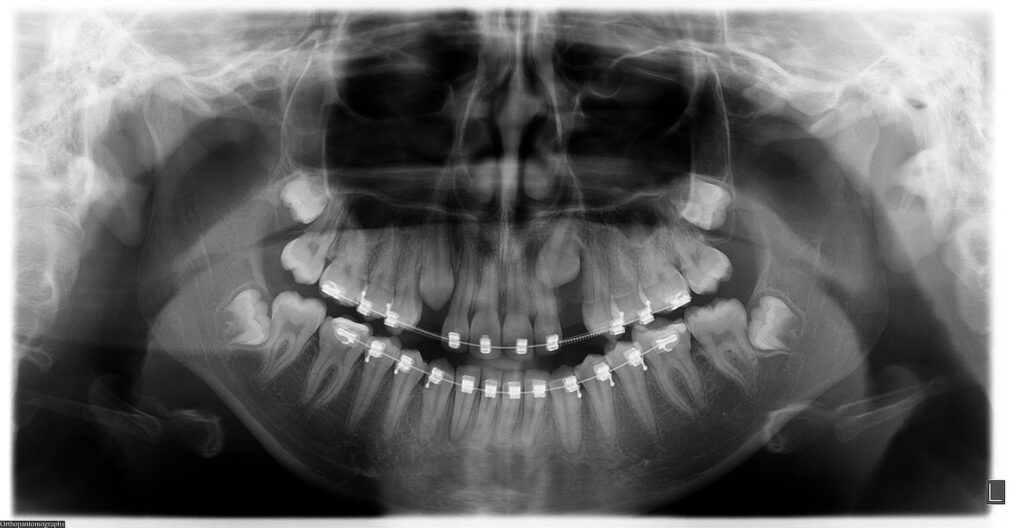 Mandibulectomía: Cirugía de Tumor en la Mandíbula