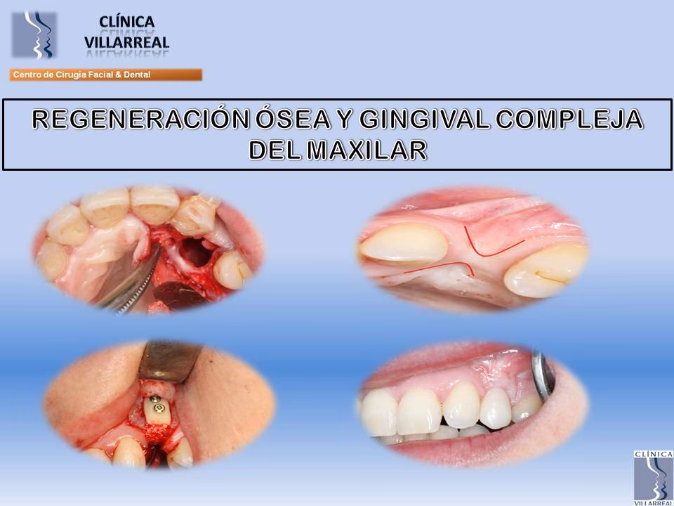 ¿Cómo se llama la cirugía en la mandíbula para quitar un tumor?