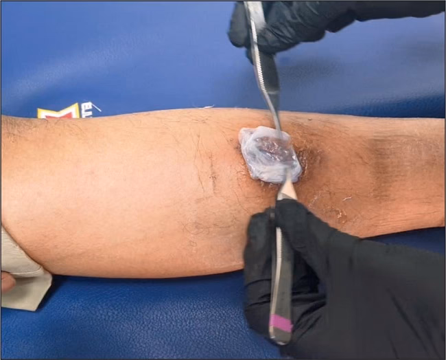 ¿Para qué se utiliza la membrana amniótica en una herida?