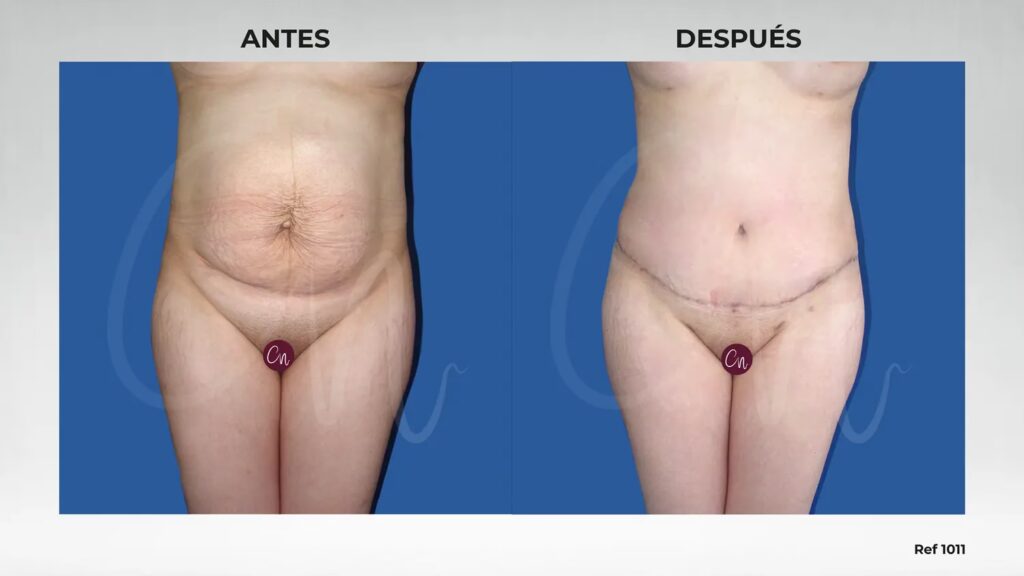 ¿Cuánto Cuesta una Liposucción? Guía de Precios