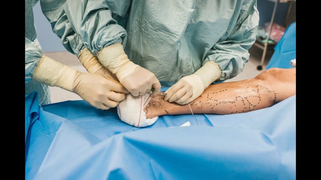 Operación de Várices: Guía Completa y Recuperación