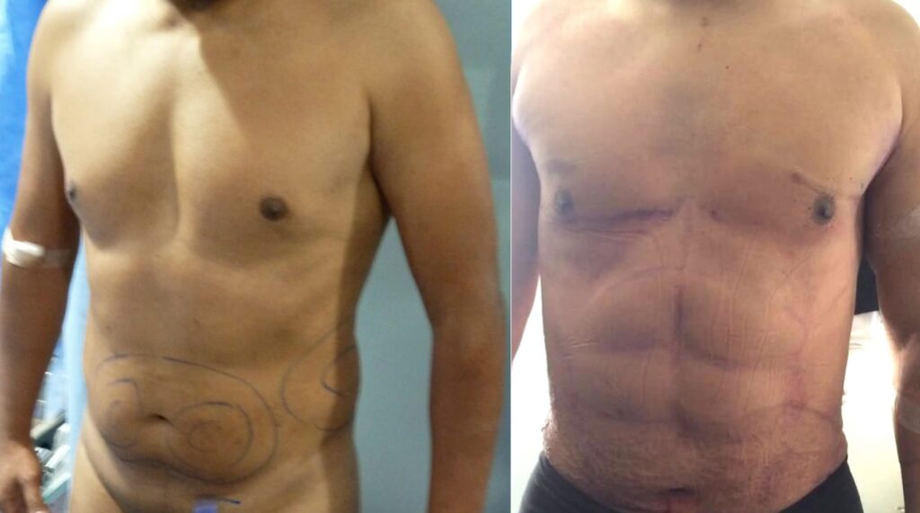 Lipo Vaser: Remodelación y Afirmación de Género