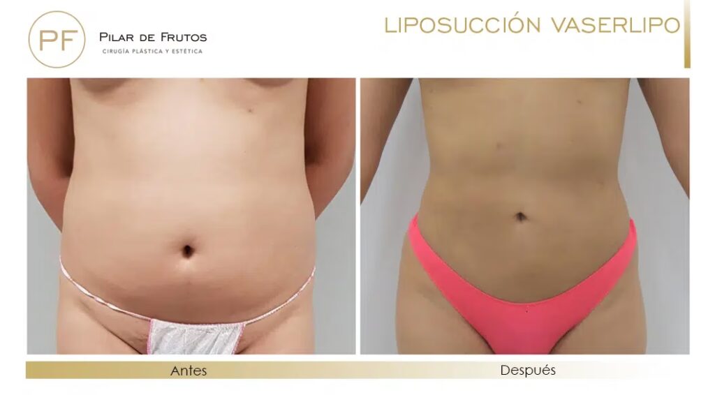 LipoVaser: La Guía Definitiva de Escultura Corporal